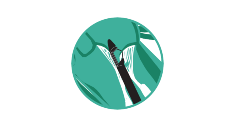 Entfernung des Geräts