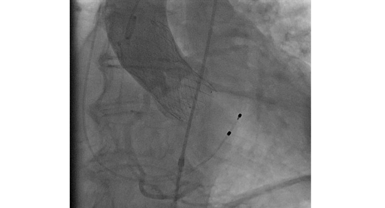 Angiographie: neue TAVI-Prothese, Medtronic Evolut FX