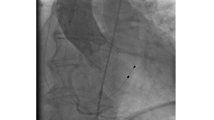 Angiographie: neue TAVI-Prothese, Medtronic Evolut FX