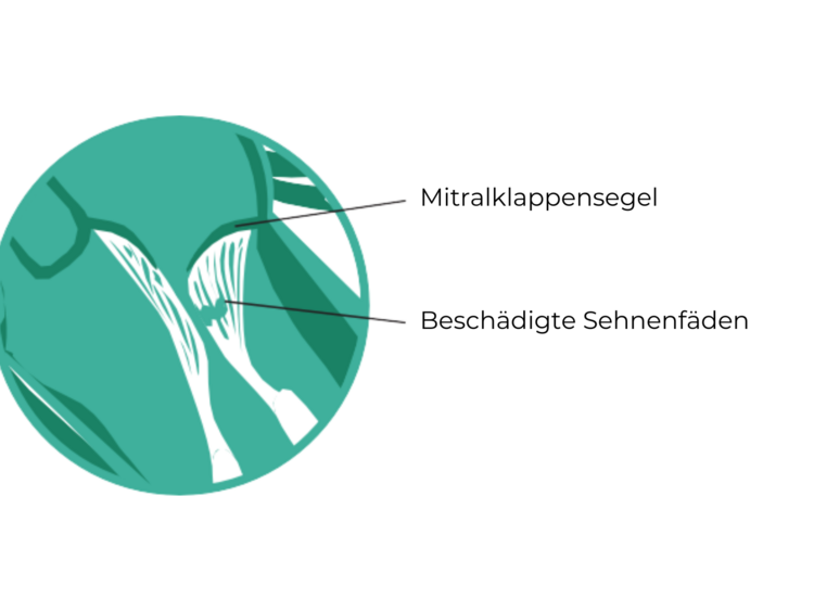 Aufbau der Herzklappe