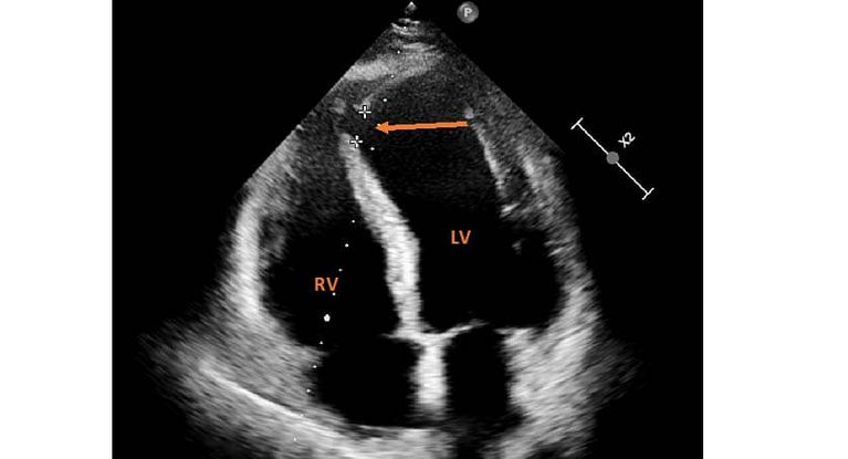 Fall des Monats: Ventrikelseptumdefekt nach Herzinfarkt ǀ MEDICLIN ...